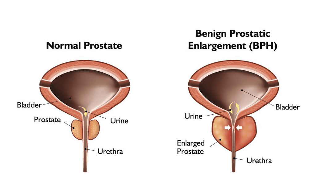 Normal Prostate vs Enlarged Prostate